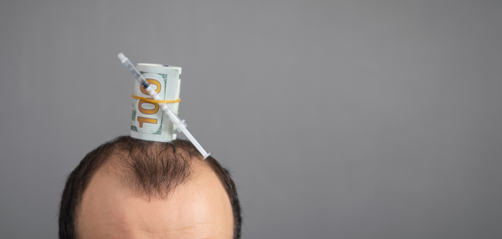 Are Hair Transplants Worth The Money?