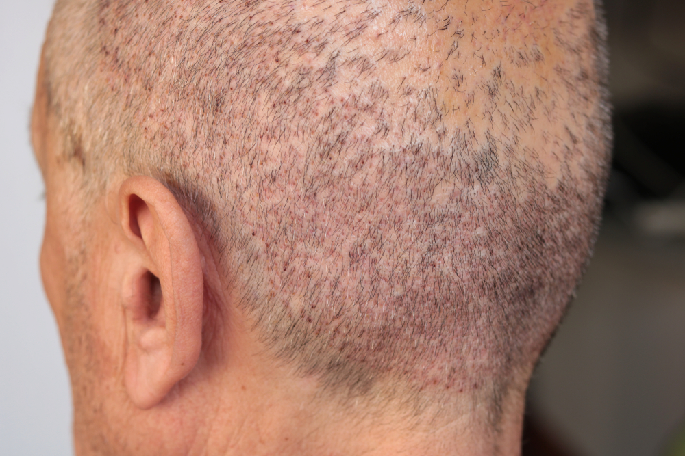 Can You Get A Hair Transplant If You Are Completely Bald?