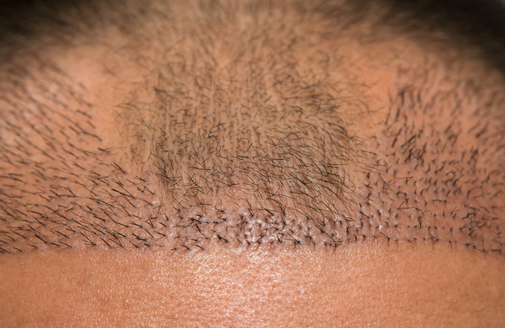 Do Hair Transplants Look Natural?