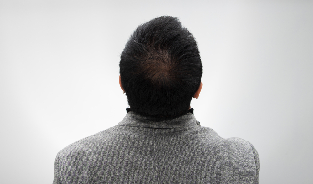 How Much Does Hair Transplant Cost In The Philippines?