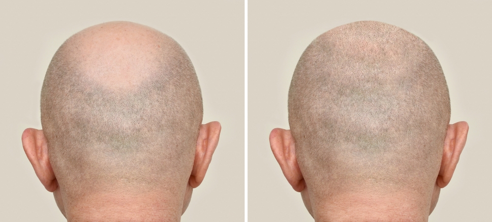 How Much Is A Full Top Hair Transplant?