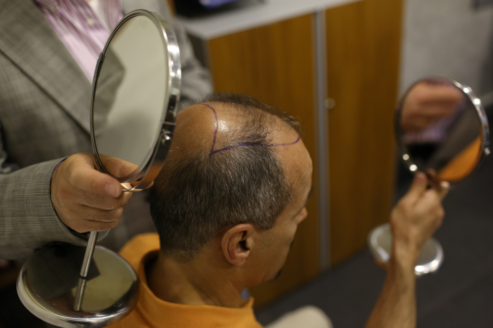 How Much Does 5000 Grafts Hair Transplant Cost In Turkey?