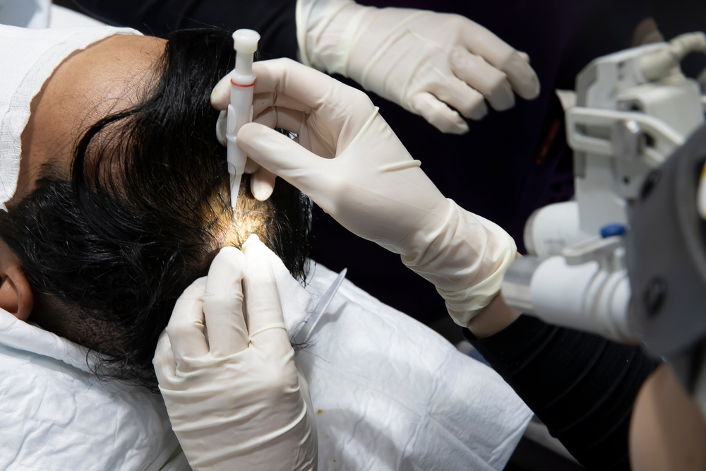 How Much Does It Cost To Get A Hair Transplant In Thailand?