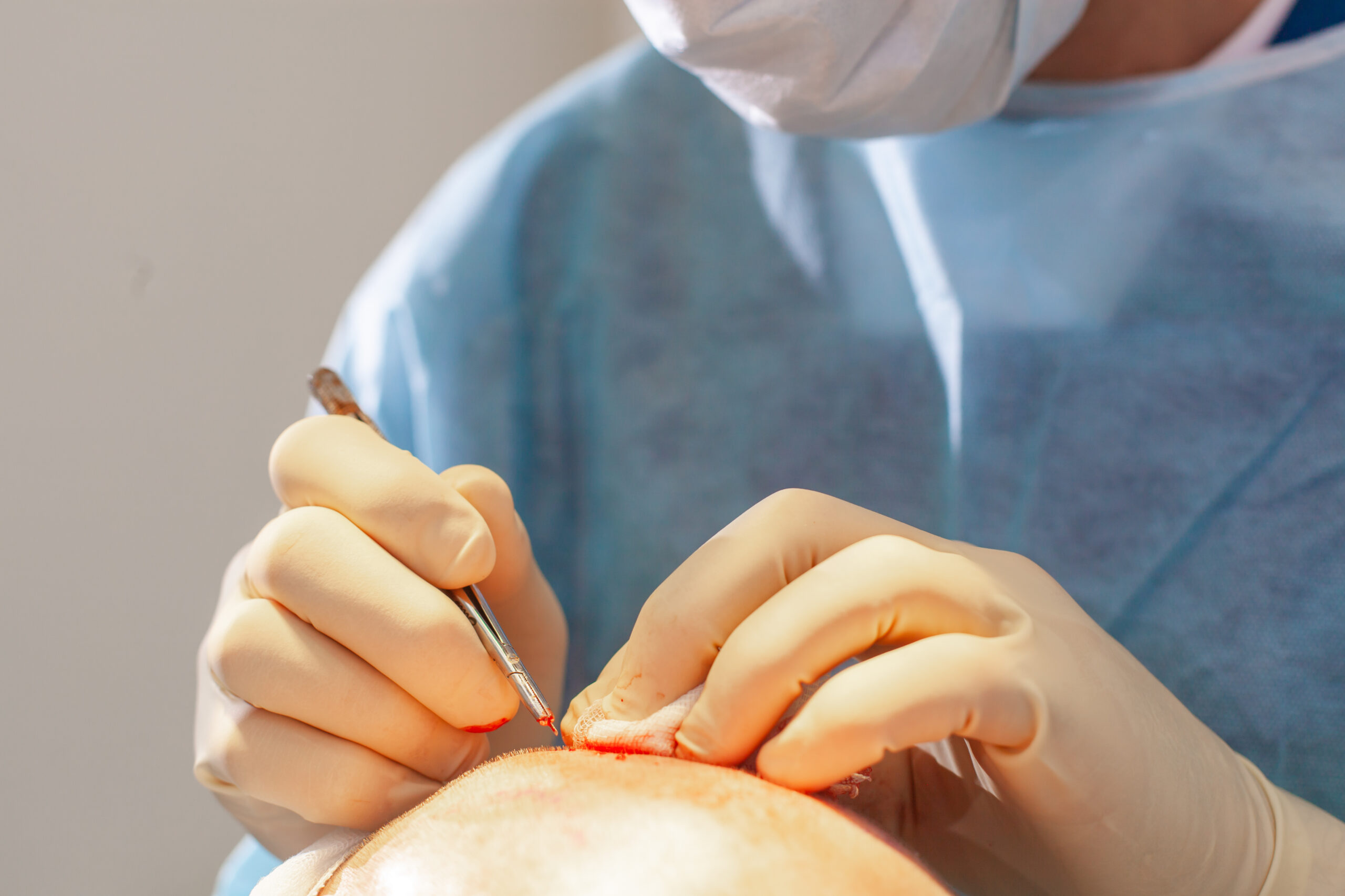 What Does 2500 Grafts Hair Transplant Cover?