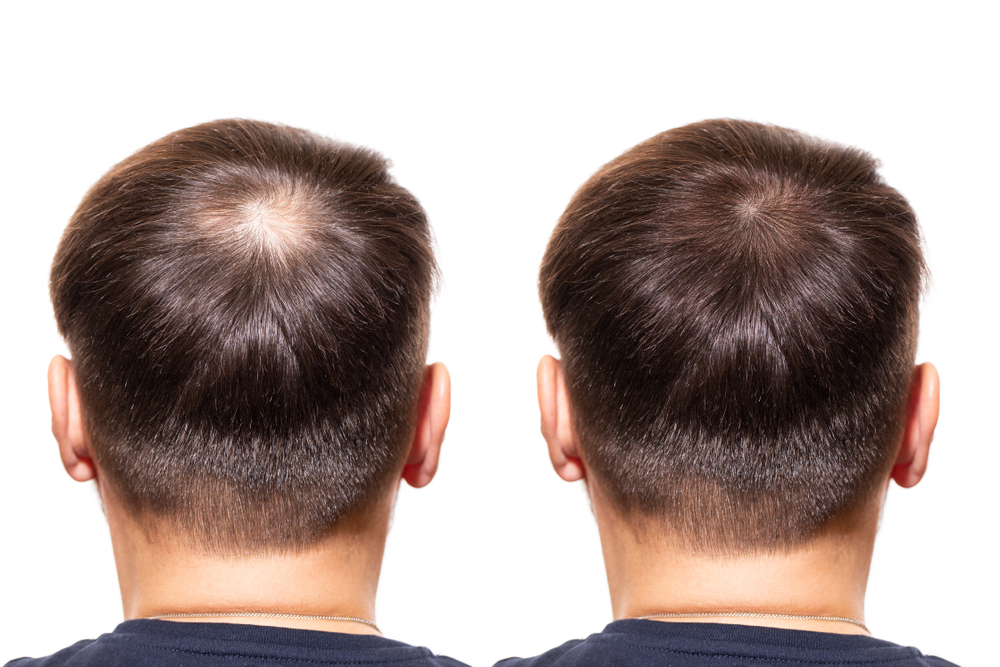 What Ethnicity Is Best For Hair Transplant?