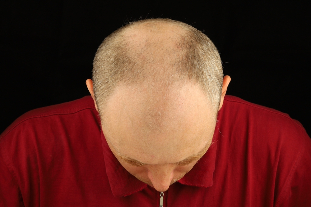 What Is Stage 7 Baldness Hair Transplant?