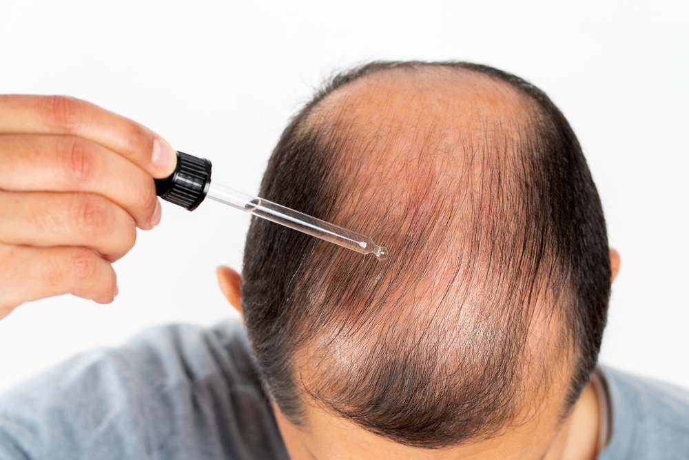 What Is The Treatment For Hair Loss?