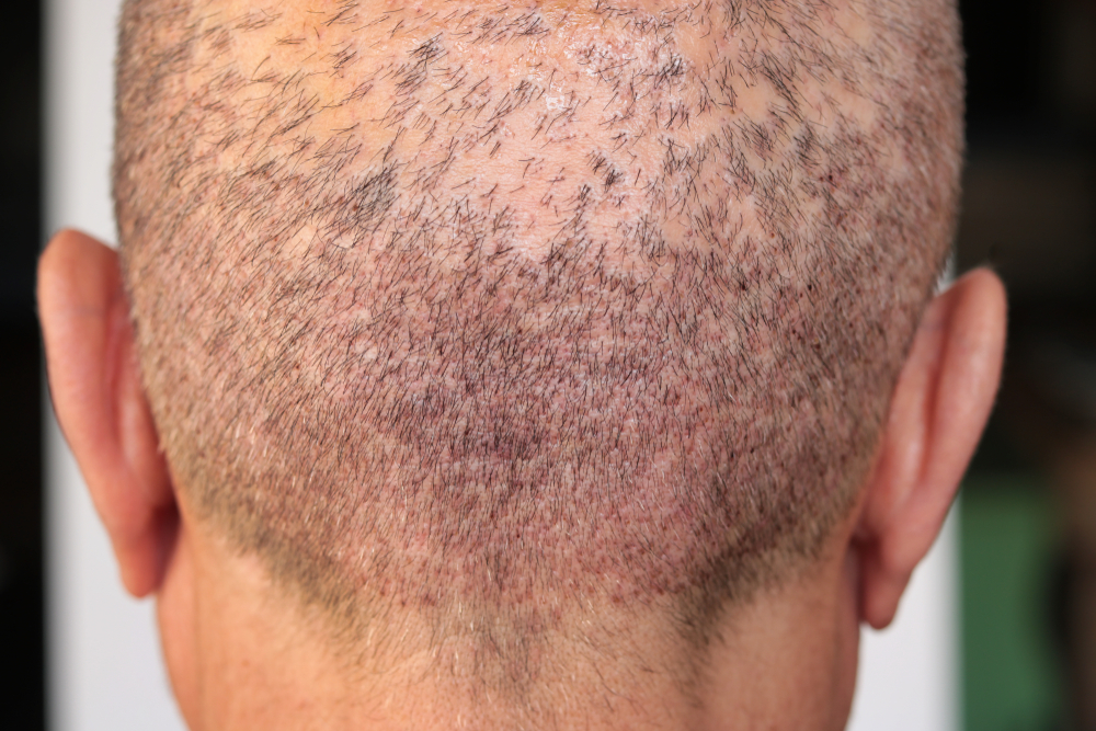 Can I Go Out 1 Week After Hair Transplant