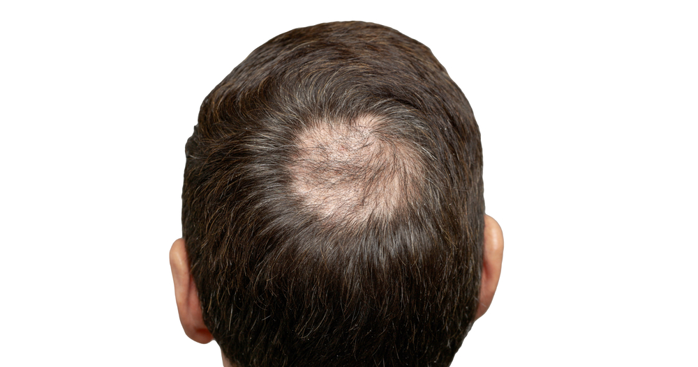 Can You Still Go Bald After A Hair Transplant