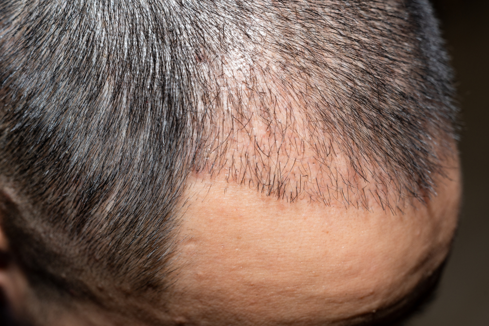 Does Transplanted Hair Turn Gray