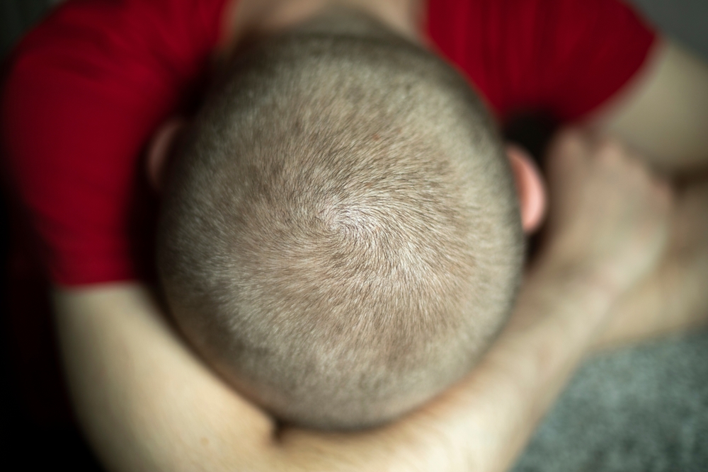 How Do You Sleep After Hair Transplant