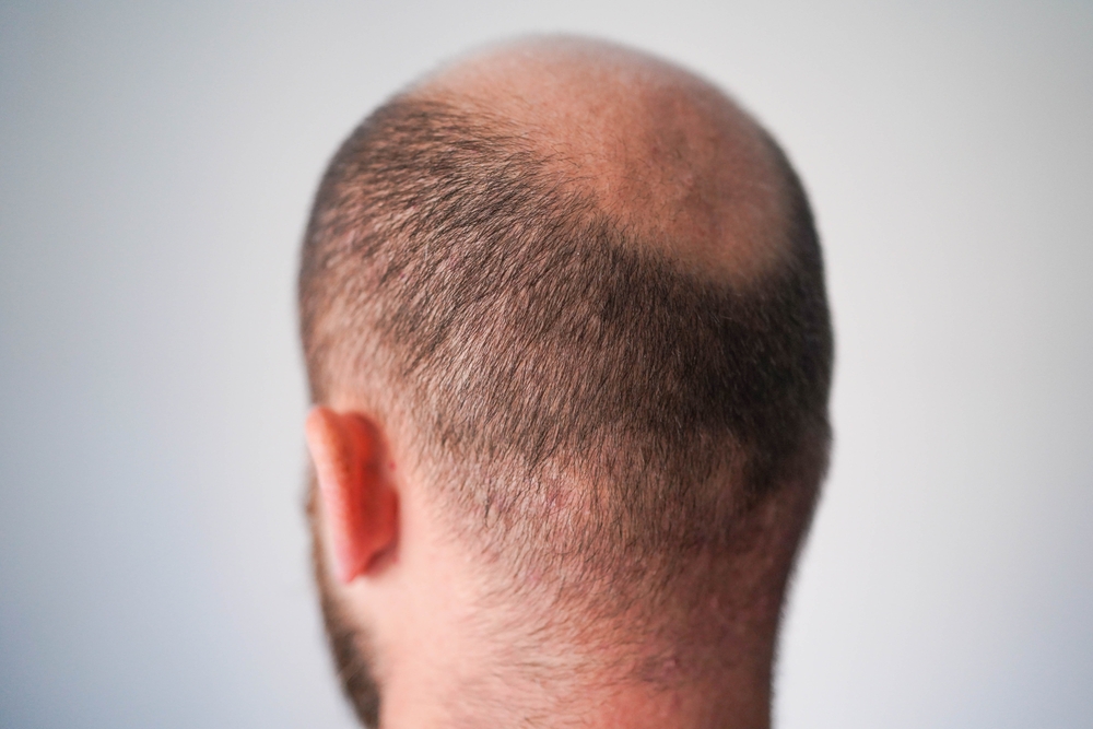 How Many Hair Transplants Can You Have In A Lifetime