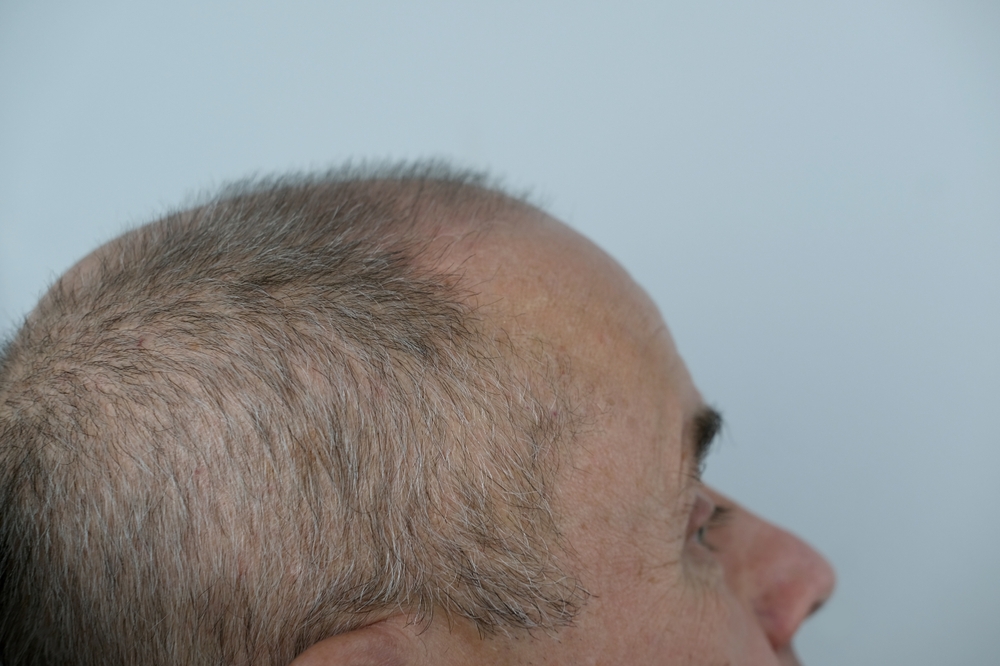 Is 50 Too Old For Hair Transplant