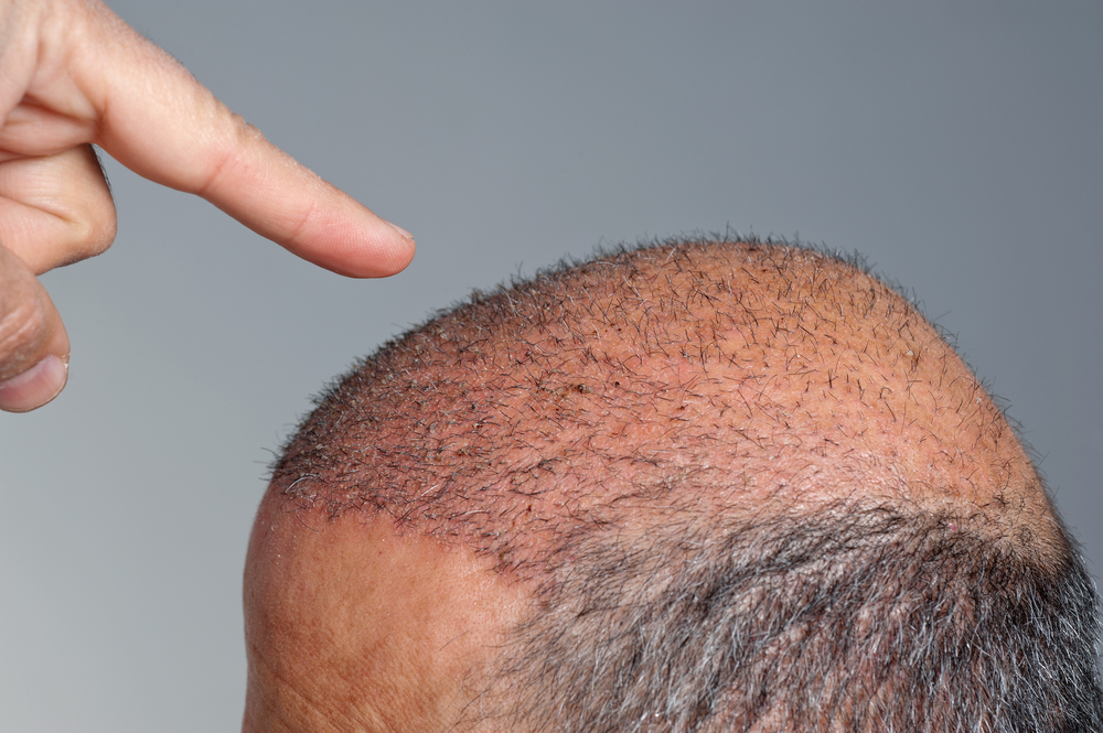 What Are The Most Crucial Days After Hair Transplant