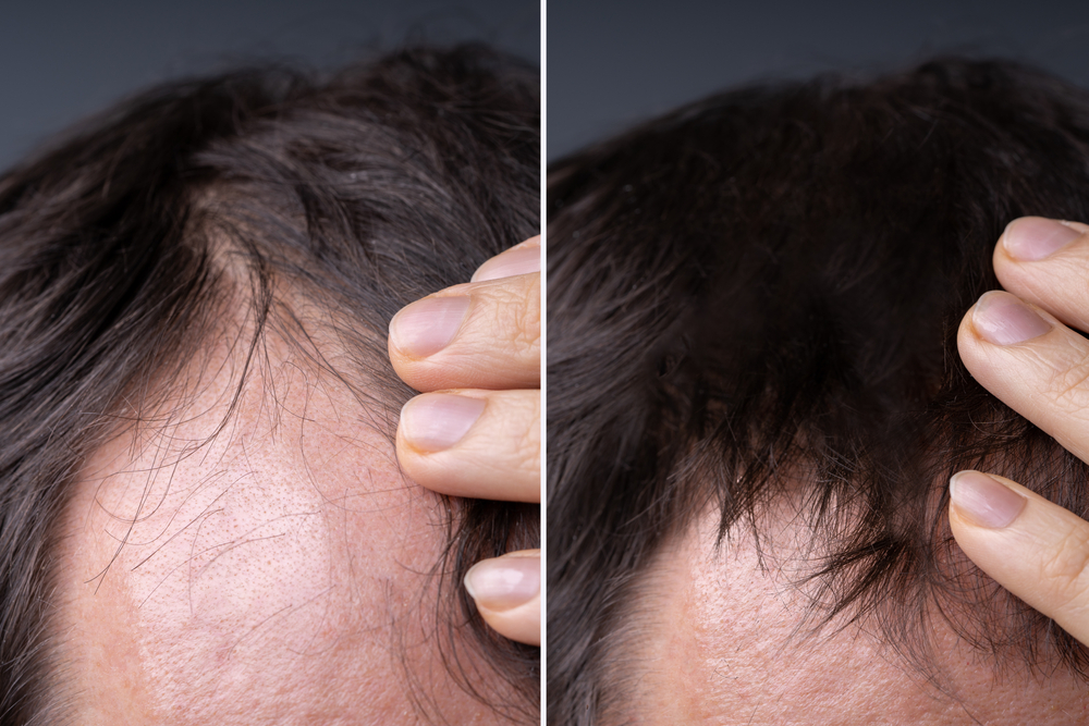 What Happens To Original Hair After Hair Transplant