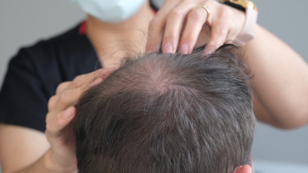 What Is The Alternative To Turkey For Hair Transplant