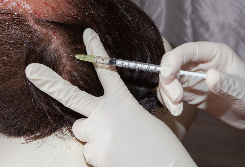 What To Expect 7 Months After Hair Transplant