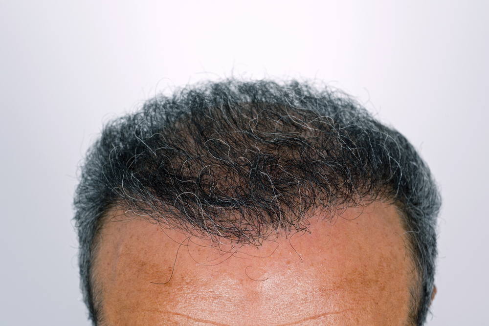 Can You Go Bald Again After Hair Transplant