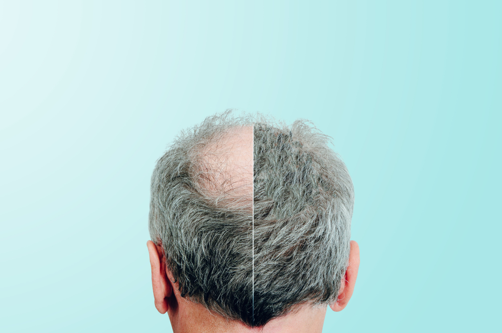 Do You Need Haircuts After Hair Transplant