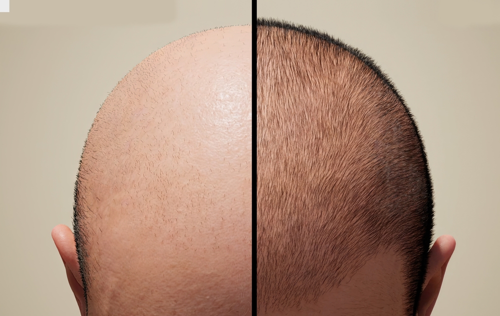 How Bald Is Too Bald For A Hair Transplant