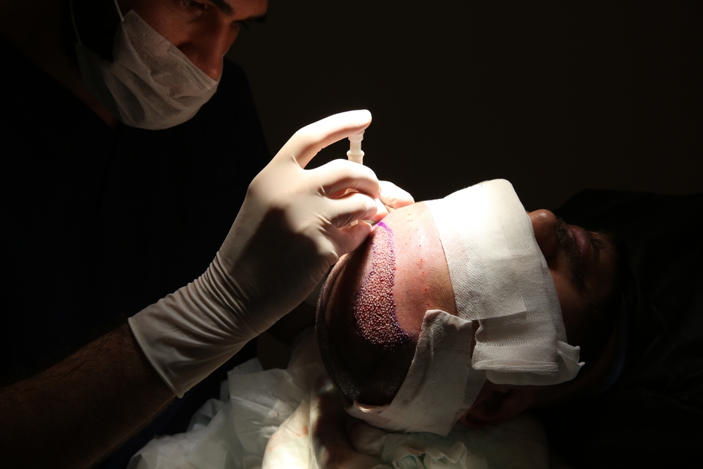 How Many Prp Sessions Are Needed After Hair Transplant