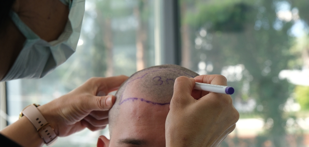 What Is The Negative Side Of Hair Transplant