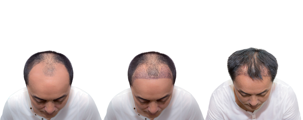 What Time Of Year Is Best For Hair Transplant