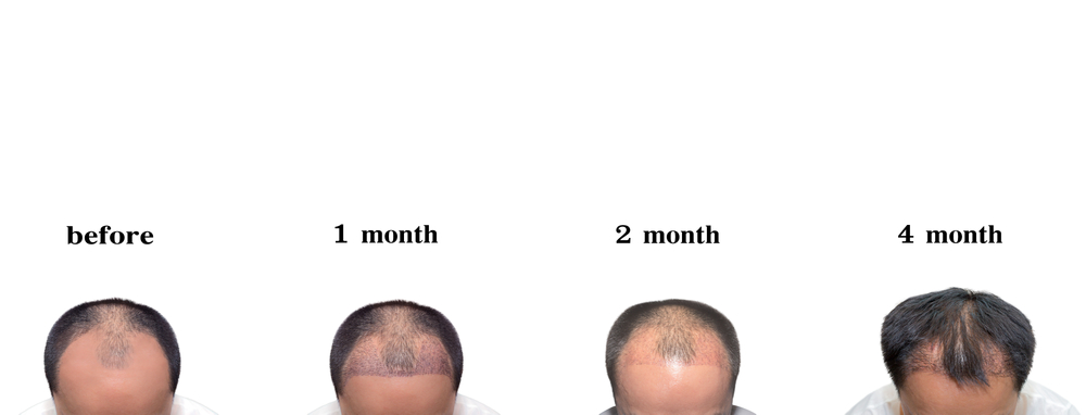 What To Expect 4 Months After Hair Transplant