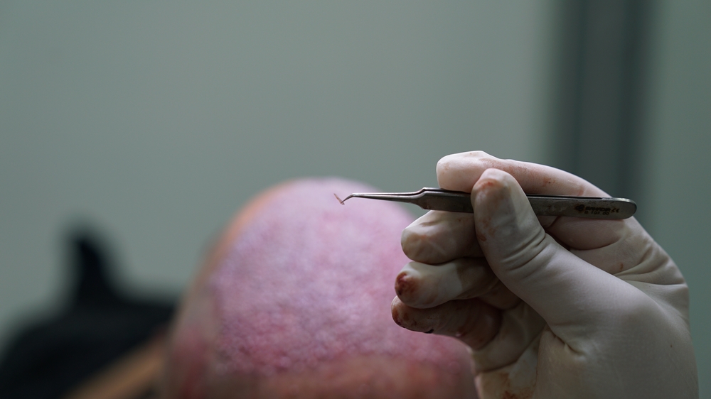 Can Grafts Fall Out After A Hair Transplant