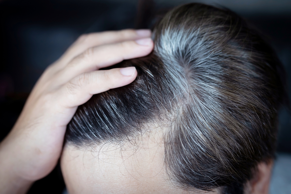 Do Hair Transplants Turn Grey