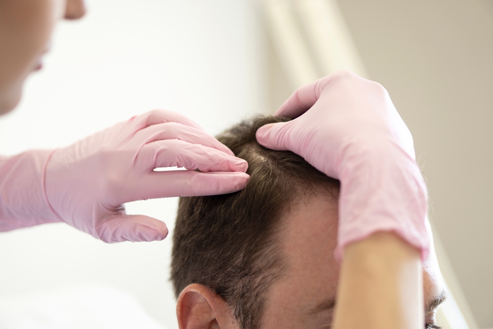 How Late Is Too Late For A Hair Transplant