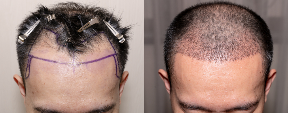 How Painful Is Recovery From Hair Transplant