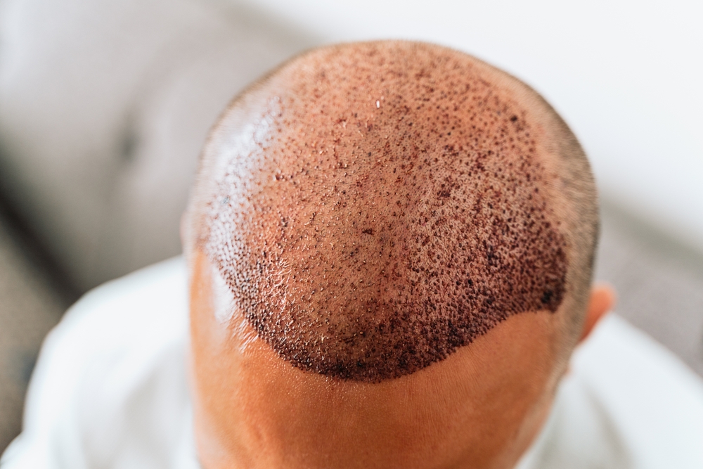 What Does A Hair Transplant Look Like After 3 Weeks