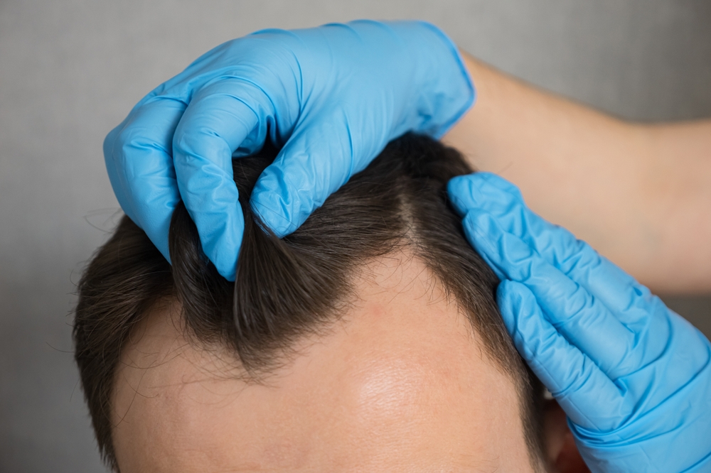 What Is The Best Age For Hair Transplant