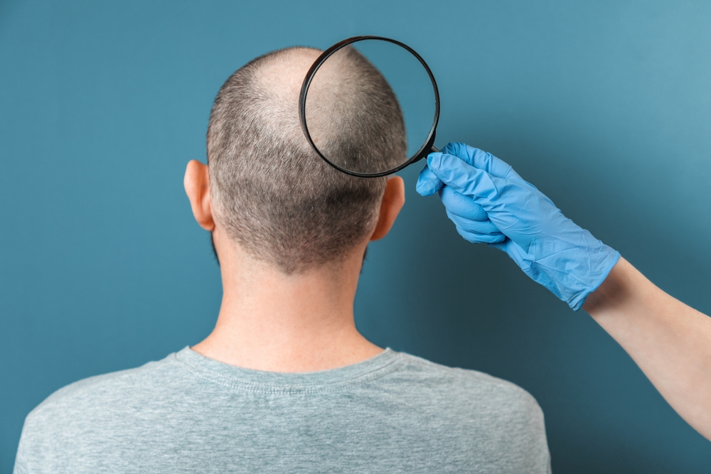 What Percentage Of Hair Transplants Go Wrong