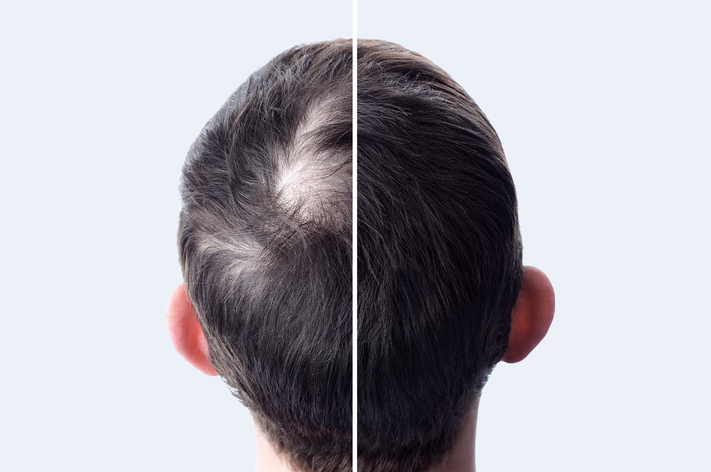 What To Expect 9 Months After Hair Transplant