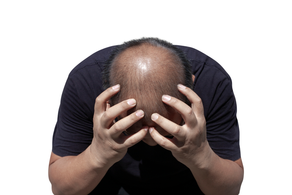 Why Do Most Hair Transplants Fail