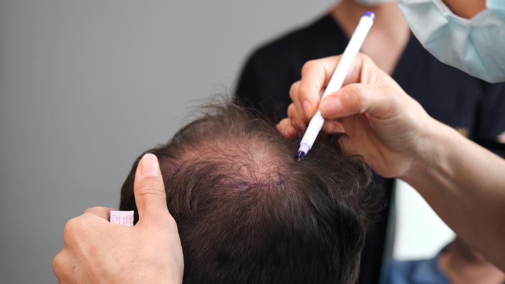 Why Turkey Is Best For Hair Transplant