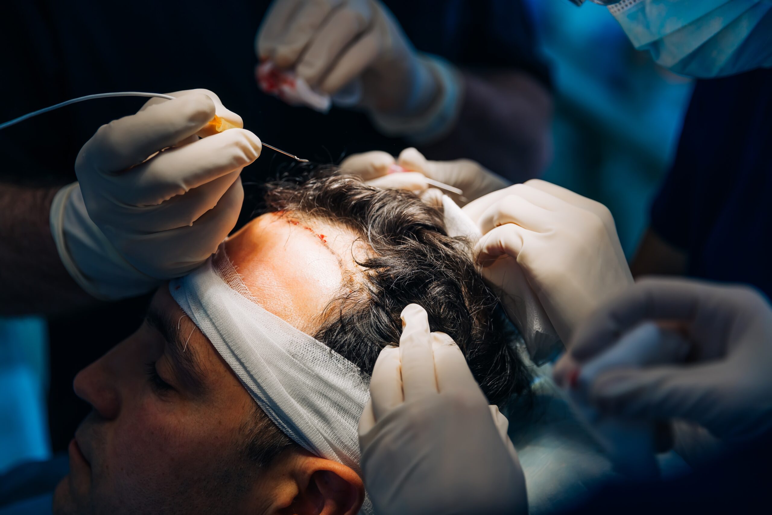 Can You Do A Hair Transplant Without Shaving