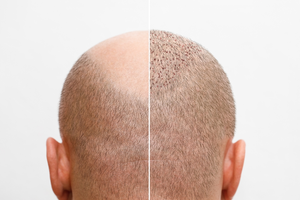 How Many Days After Hair Transplant Can I Work