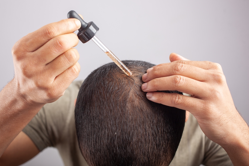 Is Minoxidil Required After Hair Transplant