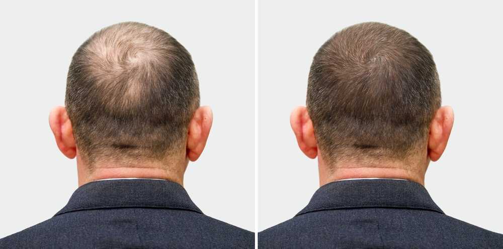 What Are The Signs Of A Good Hair Transplant