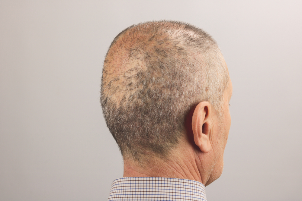 What Does A Hair Transplant Look Like After 2 Weeks