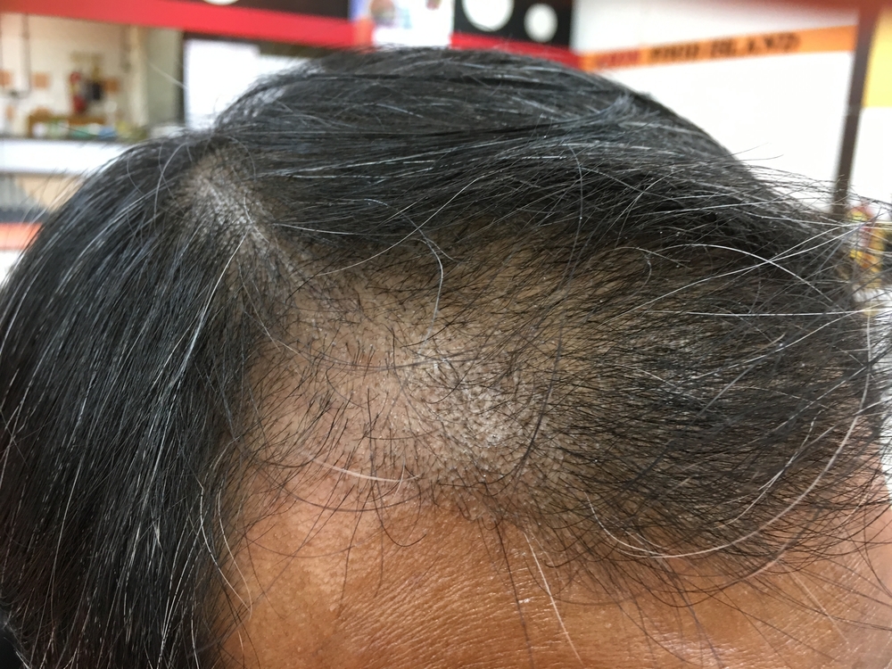 What To Expect 5 Months After Hair Transplant