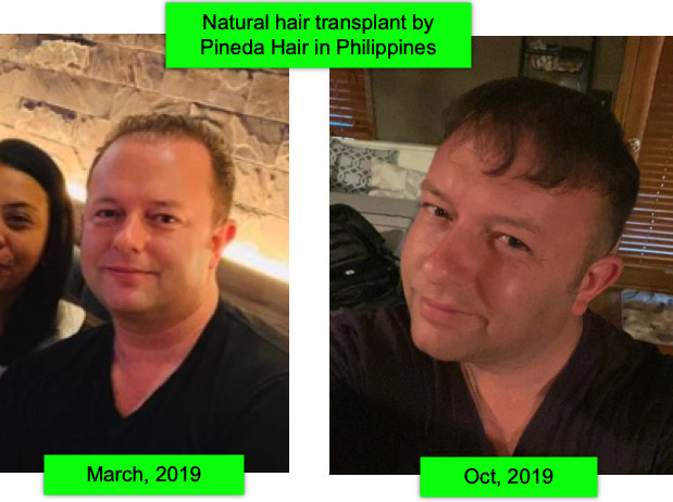 before and after hair transplant in manila, 2019